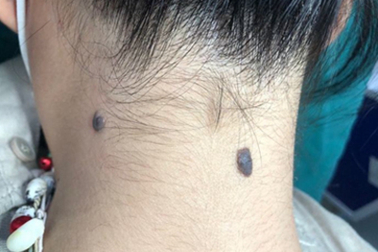 皮内痣后颈黑痣图 皮内痣后颈黑痣图