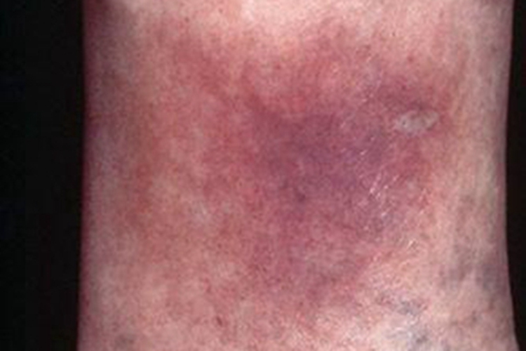 人工性脂膜炎红斑图