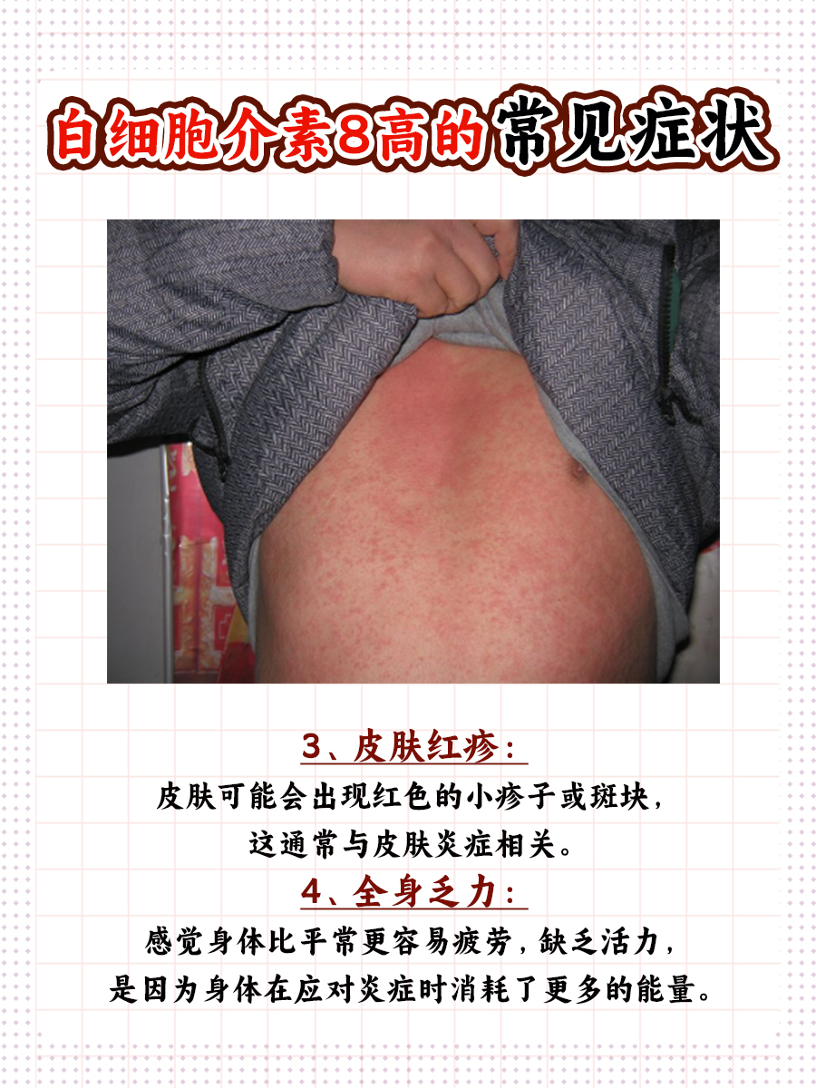 白细胞介素8高多少算严重？医生来解答