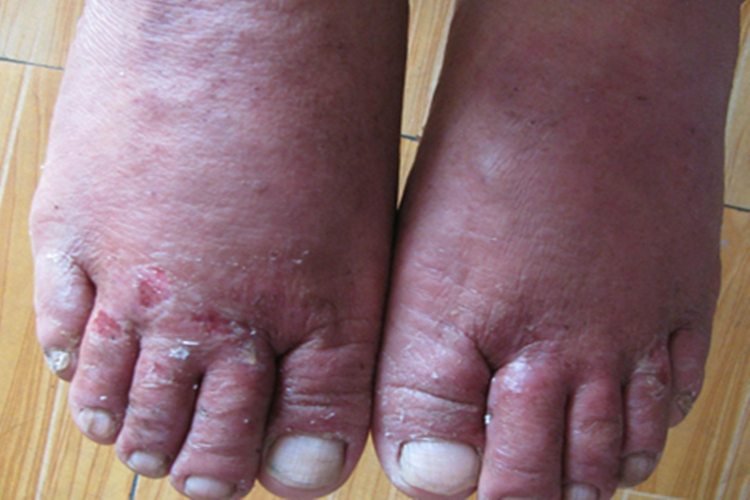 亚急性湿疹脚背红斑图 亚急性湿疹脚背红斑图