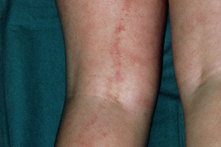 颚口线虫病腿部症状图 颚口线虫病腿部症状图