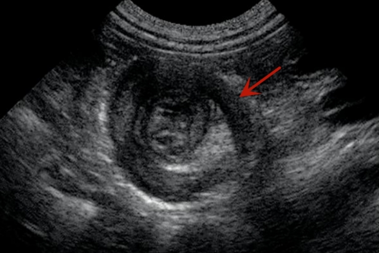 肠梗阻X线同心圆状图