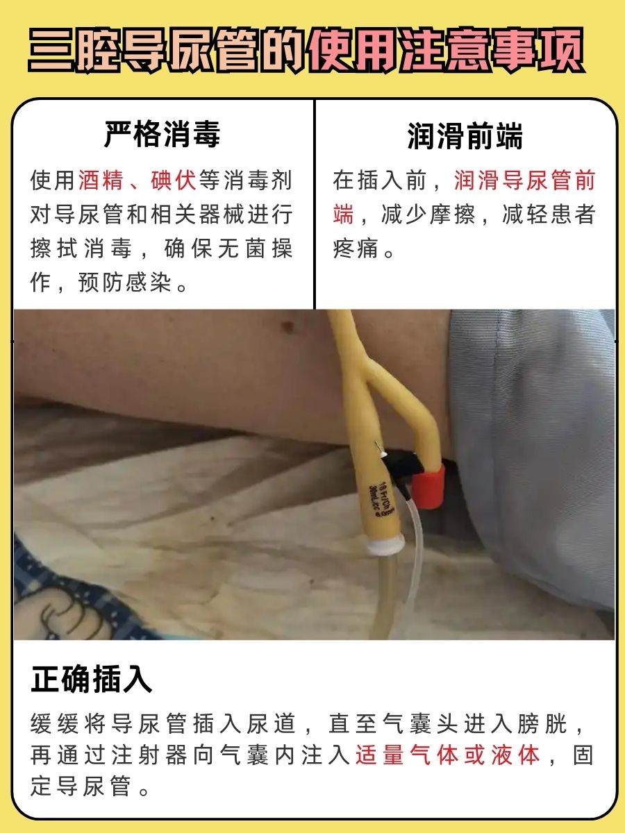 新手必看！三腔导尿管三个端口区分法