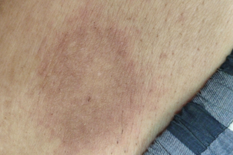 慢性湿疹腹部斑图