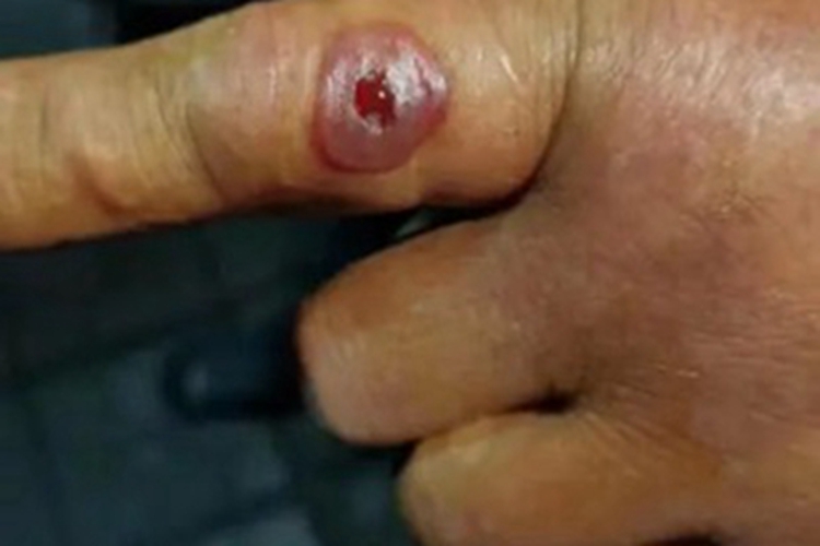 皮肤炭疽渗液图 皮肤炭疽渗液图