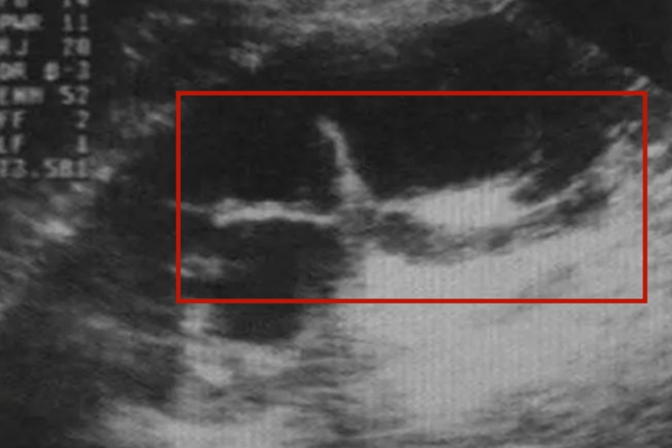 病理性肾盂分离图 病理性肾盂分离图