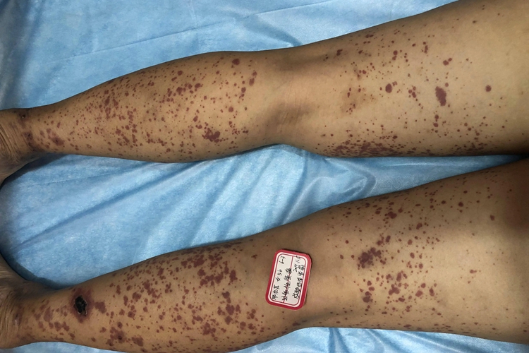 艾滋病初期血块图片