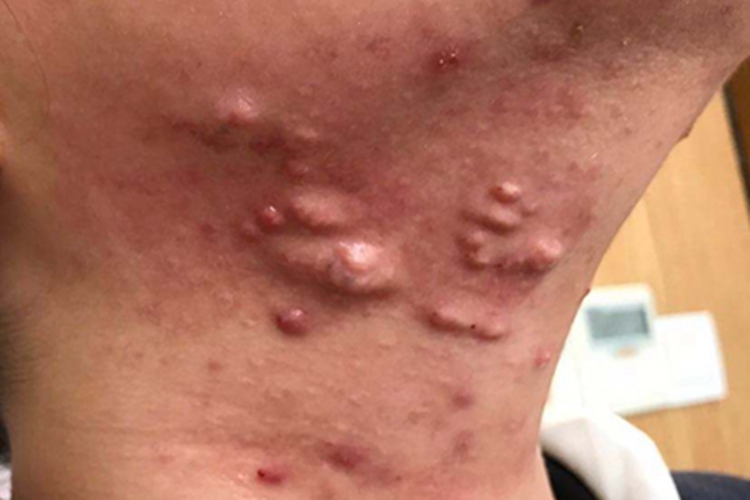 聚合性痤疮前颈症状图