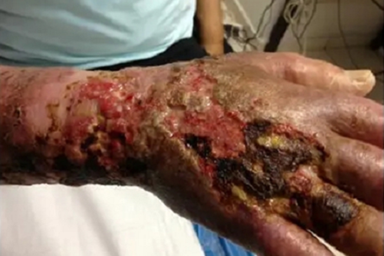 坏疽性脓皮病手背症状图 坏疽性脓皮病手背症状图