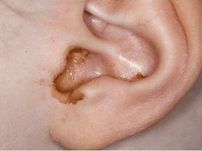 霉菌性外耳道炎的症状和图片 - 有来医生