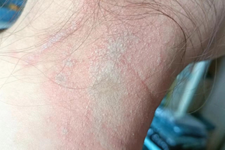 隐翅虫皮炎颈部小水疱图