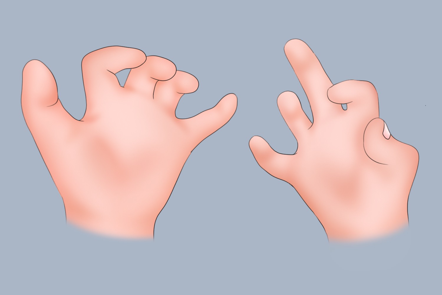 新生儿关节挛缩图