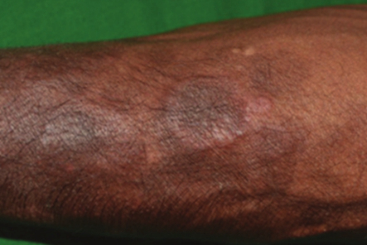 持久性隆起性红斑腿症状图