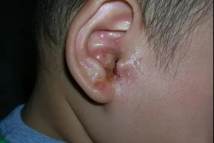 小孩耳部湿疹图