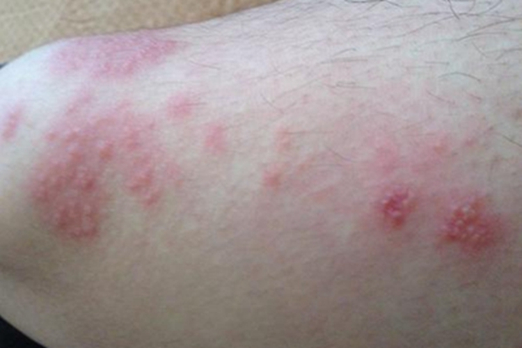 穿通性毛囊炎腿症状图