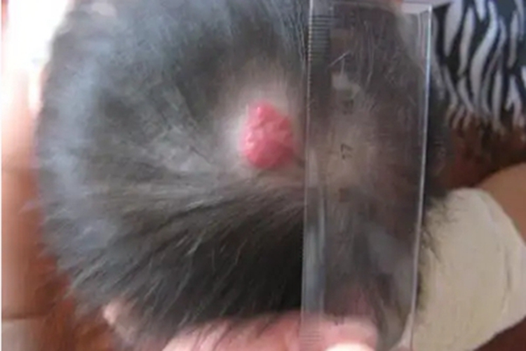 特发性头颈部血管肉瘤头皮肉球图 特发性头颈部血管肉瘤头皮肉球图