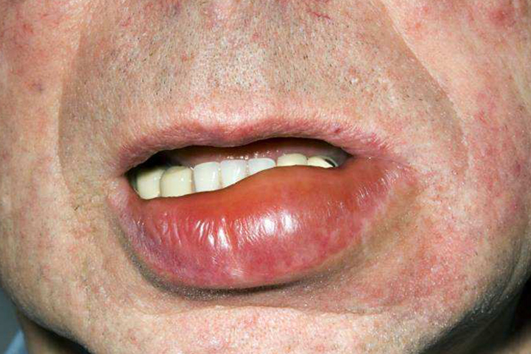 非凹陷性水肿嘴唇肿胀图 非凹陷性水肿嘴唇肿胀图