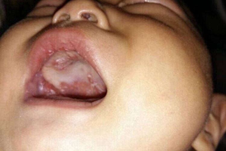 溃疡性口炎口腔白斑图 溃疡性口炎口腔白斑图