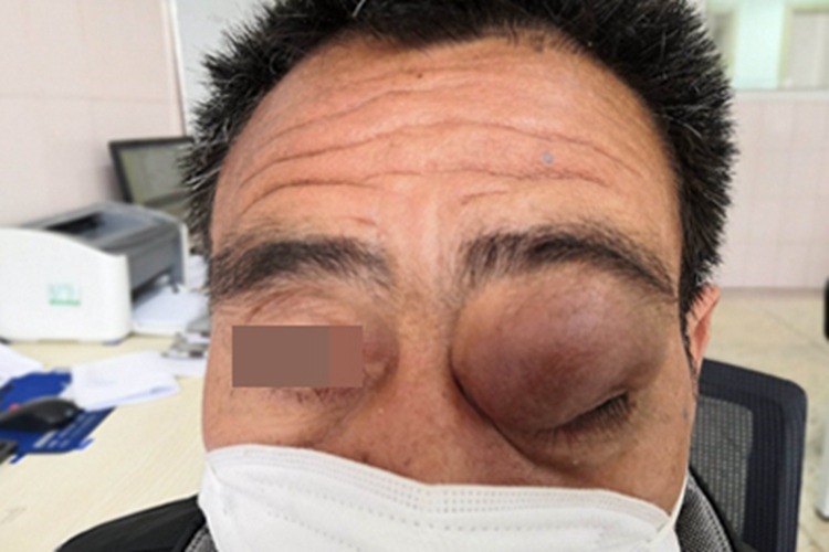 眼眶畸胎瘤眼部肿块图