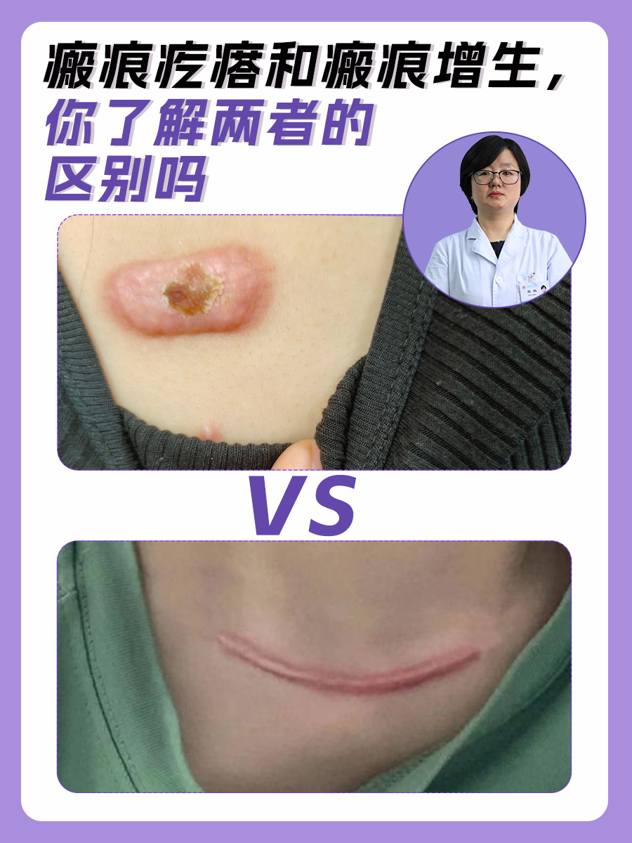 瘢痕疙瘩和瘢痕增生，你了解两者的区别吗