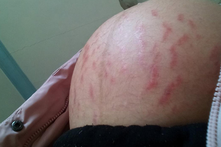 肚子上有红色萎缩纹图 肚子上有红色萎缩纹图