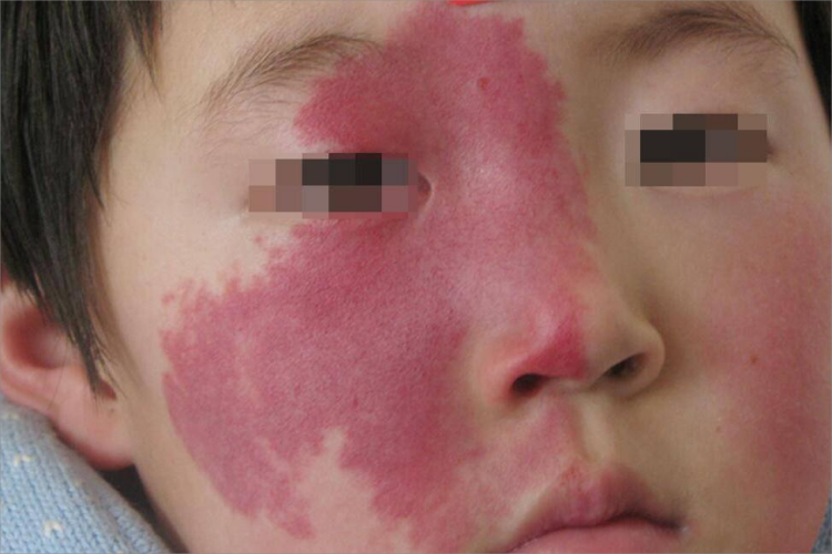 血管型胎记面部斑图 血管型胎记面部斑图