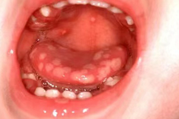 原发性口腔单纯性疱疹舌头水疱图 原发性口腔单纯性疱疹舌头水疱图