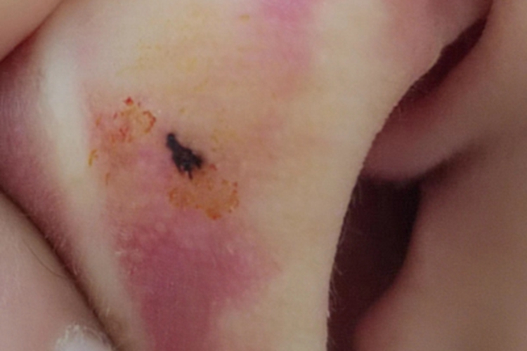 交界痣耳朵上有黑色痣图