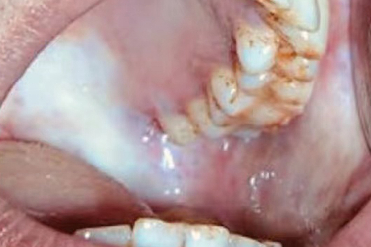 口腔黏膜下纤维性变图