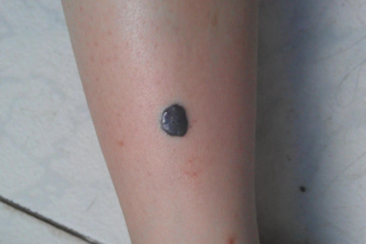 蓝色橡皮疱样痣小腿长斑图