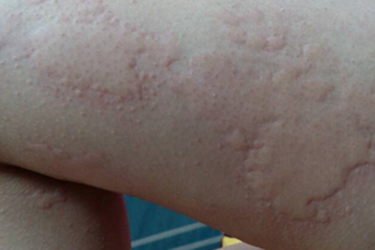 荨麻疹性血管炎大腿症状图 荨麻疹性血管炎大腿症状图