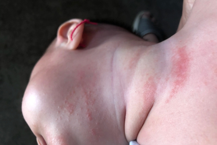 急性湿疹宝宝脖子有红斑图 急性湿疹宝宝脖子有红斑图