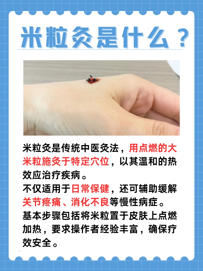 医生为你揭开：米粒灸是什么的神秘面纱