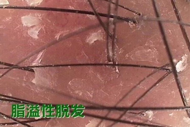 不健康头皮毛囊检测图