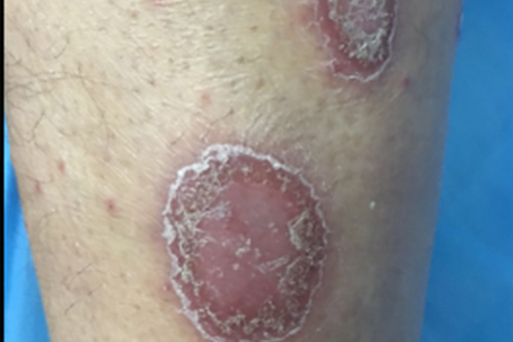 钱币状寻常型银屑病图