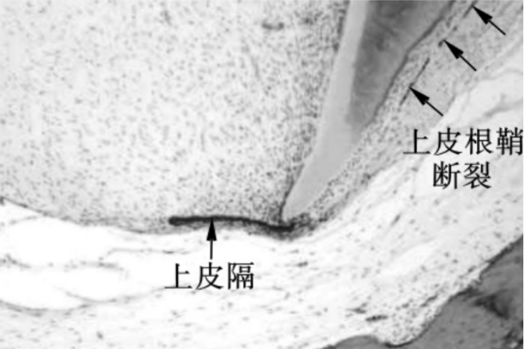 上皮根鞘断裂图