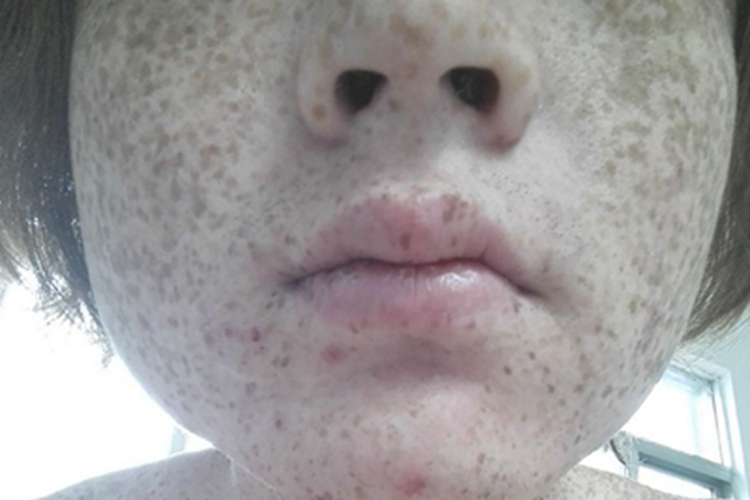 泛发性黑子病面部黑斑图 泛发性黑子病面部黑斑图