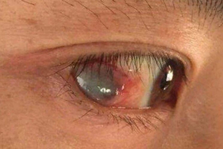 巩膜葡萄肿症状图 巩膜葡萄肿症状图