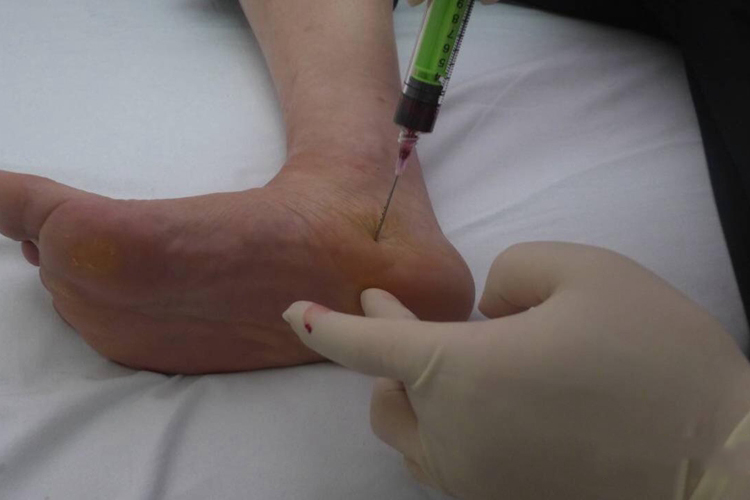 踝关节前内侧注射图