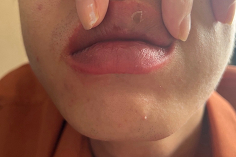 唇炎嘴唇结痂症状图