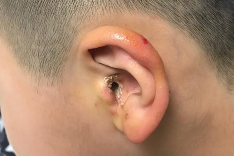 外耳道慢性湿疹图 外耳道慢性湿疹图