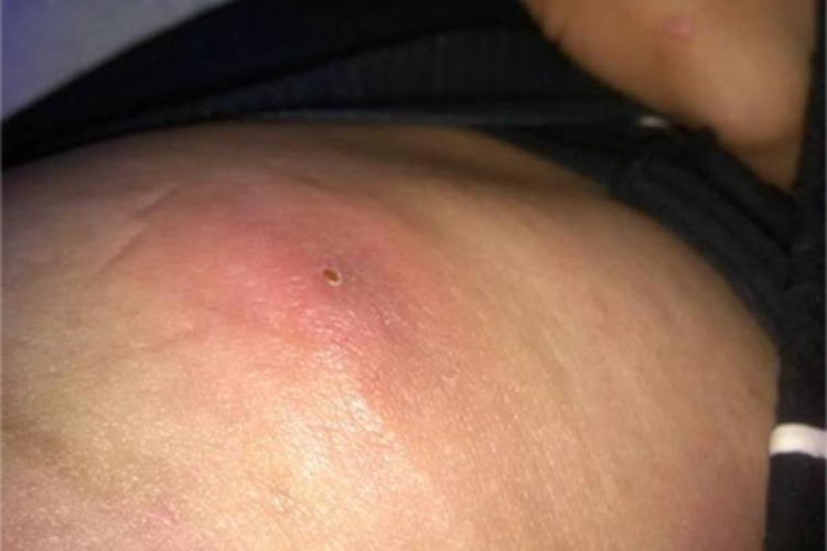 虱病腰部大红疙瘩图 虱病腰部大红疙瘩图