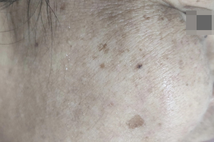 脂溢性角化病脸上斑块图
