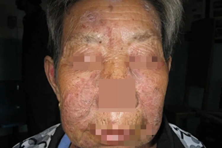 疱疹样天疱疮面部皮肤粗糙图