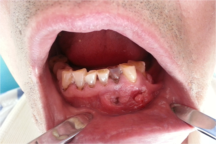 颌骨囊肿破溃图