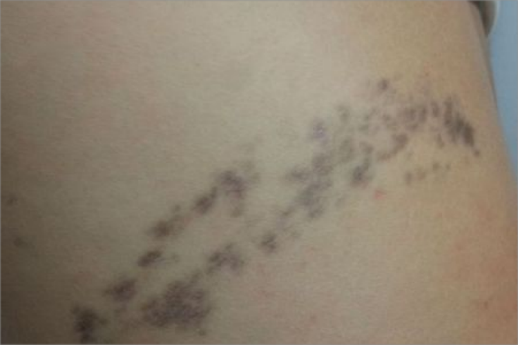 孩子后背外伤紫色条纹图