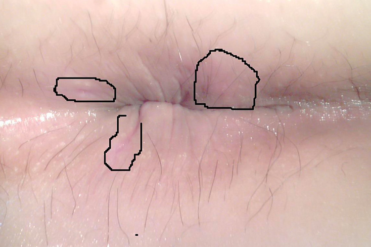 肛瘘早期肛周瘘口形成图