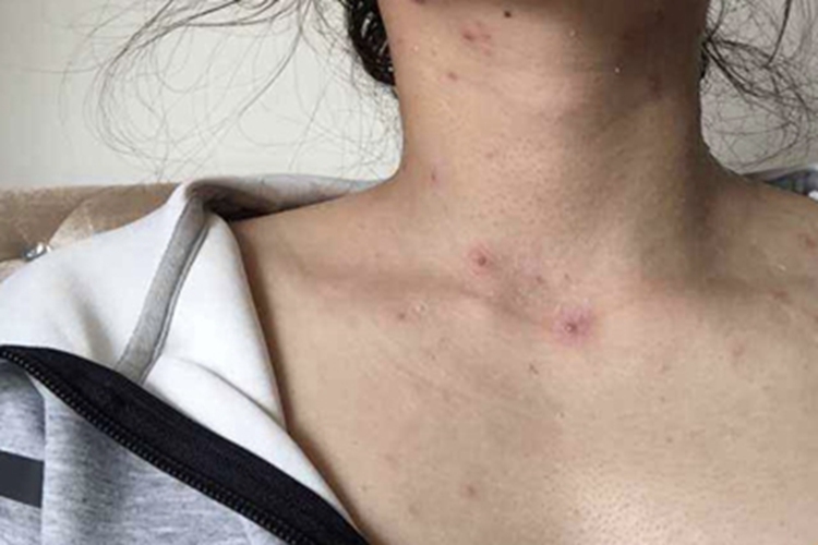 革螨皮炎前颈症状图