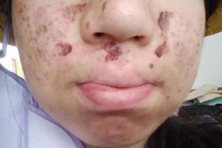 痘痘结痂脱落图