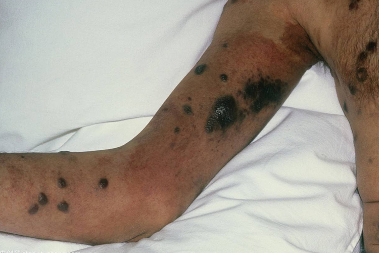 男性艾滋病卡波西肉瘤图 男性艾滋病卡波西肉瘤图